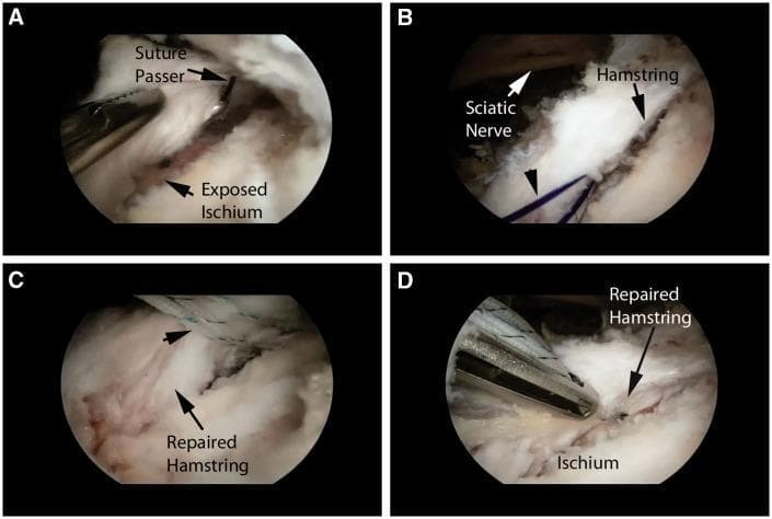This four-panel (A-D) figure demonstrates the endoscopic repair of a proximal hamstring tendinous avulsion from the ischial tuberosity. (A) Shows the preparation of the bleeding corticocancellous bed on the exposed ischium, with a suture passer ready to penetrate the tendon tissue. (B) Highlights a shuttle suture (black arrowhead) placed through the hamstring tendon. Crucially, the image illustrates the immediate anatomical proximity of the sciatic nerve (white arrow) to the surgical site, emphasizing the need for nerve protection during suture management. (C) Displays multiple mattress sutures secured within the substance of the hamstring tendon to reapproximate it to the bone. (D) Shows the completed repair with the hamstring tendon firmly anchored back to the ischium. The series illustrates an endoscopic orthopedic procedure utilizing suture anchors and arthroscopic techniques to treat proximal hamstring ruptures while managing critical neurovascular structures like the sciatic nerve.