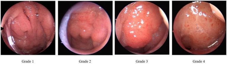 This clinical comparison chart presents four nasoendoscopic images illustrating the grading of adenoid hypertrophy according to the Parikh grading standard. The images provide a sequential view of the nasopharynx, focusing on the relationship between adenoid tissue and adjacent anatomical landmarks. Grade 1 shows a small adenoid mass with a clearly patent airway and visible surface folds. Grade 2 demonstrates moderate enlargement, reducing the airway space while maintaining visible landmarks such as the vomer bone. Grade 3 exhibits significant hypertrophy where the adenoid tissue occupies more than two-thirds of the choanal space, partially obscuring the Eustachian tube pillow. Grade 4 represents severe obstruction, with the adenoid tissue making contact with the soft palate and completely or near-completely obstructing the posterior nasal choana. Visually, the progression shows the tissue shifting from a small, pink, textured mass to a large, bulbous, and sometimes erythematous structure with prominent vascularity. This diagnostic series is essential for Otolaryngology (ENT) students to understand the endoscopic evaluation of pediatric airway obstruction and sleep-disordered breathing.