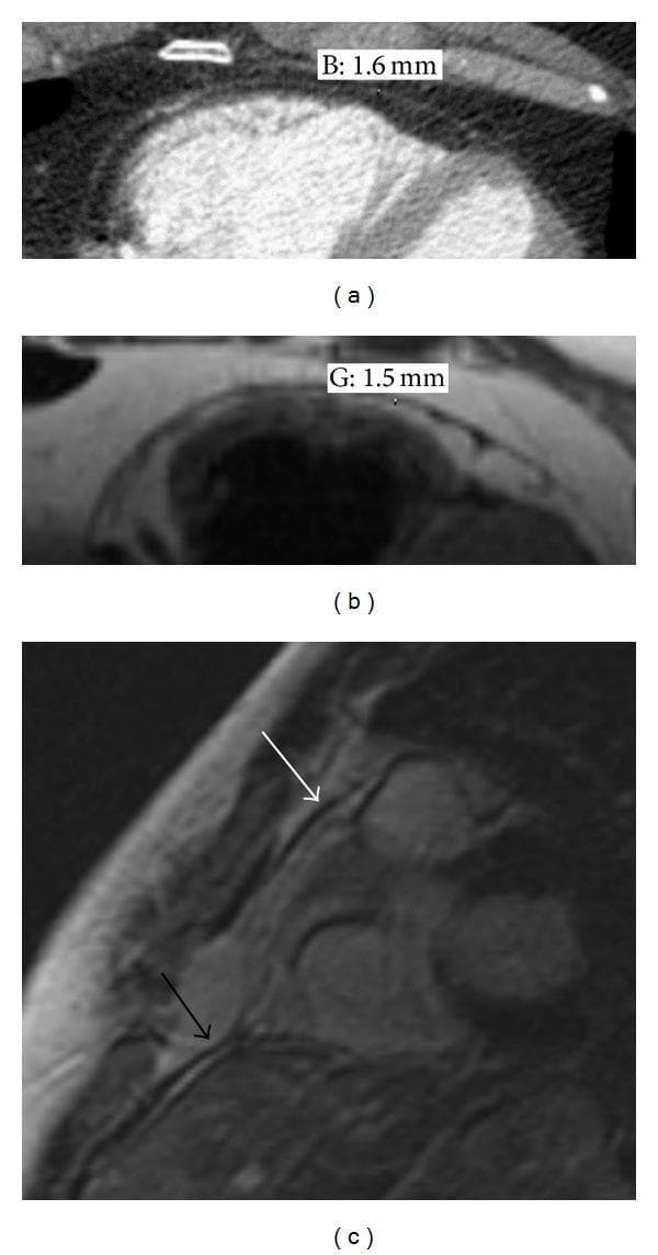 This composite of diagnostic images illustrates the normal anatomy and appearance of the human pericardium using multiple modalities. Panel (a) shows a gated contrast-enhanced axial CT image where the normal pericardium is visible as a thin, radiopaque line (measured at 1.6 mm) positioned between the epicardial and pericardial fat layers. Panel (b) provides an axial double inversion recovery MRI of the same patient, demonstrating a similar thickness (1.5 mm), where the parietal and visceral layers appear as a single indistinguishable band. Panel (c) presents a sagittal post-contrast gradient MR image highlighting the stabilizing ligaments of the heart. A white arrow identifies the pericardial-sternal ligament connecting the pericardium to the posterior sternum, while a black arrow indicates the pericardial-diaphragmatic ligament. These images serve as an educational reference for normal pericardial thickness (typically ≤2 mm) and the structural relationships between the pericardial sac, surrounding adipose tissue, and musculoskeletal anchors in the mediastinum.