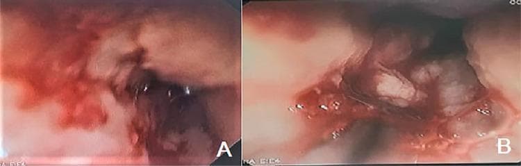 This composite diagnostic image displays two panels (A and B) of a digestive endoscopy within the esophagus, illustrating different stages or manifestations of esophageal pathology. Panel A shows esophageal candidiasis, characterized by confluent, elevated white plaques that are firmly adhered to the esophageal wall. The surrounding mucosa exhibits significant hyperemia (redness) and friable membranes, typical of fungal infection. Panel B demonstrates severe ulcerative esophagitis, featuring extensive, circumferential ulcerations. These lesions are covered with thick, white fibrin exudate and show active bleeding and signs of mucositis. The visual differences between the panels serve to educate on the endoscopic appearance of infectious candidal plaques versus severe erosive/ulcerative injury, which in this clinical context may be related to drug-induced hypersensitivity or secondary infection. The image is a critical tool for training in gastroenterology and internal medicine regarding the identification of esophageal mucosal diseases.