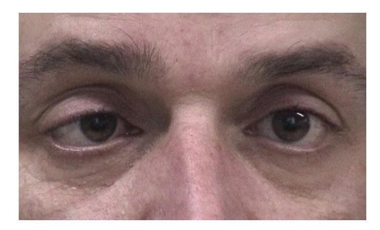 A close-up clinical photograph of the periorbital region in an adult male, demonstrating ocular misalignment consistent with right esotropia. While the left eye maintains a primary forward gaze, the right eye shows significant medial deviation toward the nasal bridge. The image illustrates a manifest strabismus, which clinically correlates with a sixth nerve (abducens) palsy, causing an inability to abduct the right eye and resultant convergent misalignment. The pupils appear slightly dilated, and the surrounding skin and eyelids show no acute inflammatory changes. This visual is intended for medical education regarding neuro-ophthalmological examination, cranial nerve palsies, and ocular motility disorders.