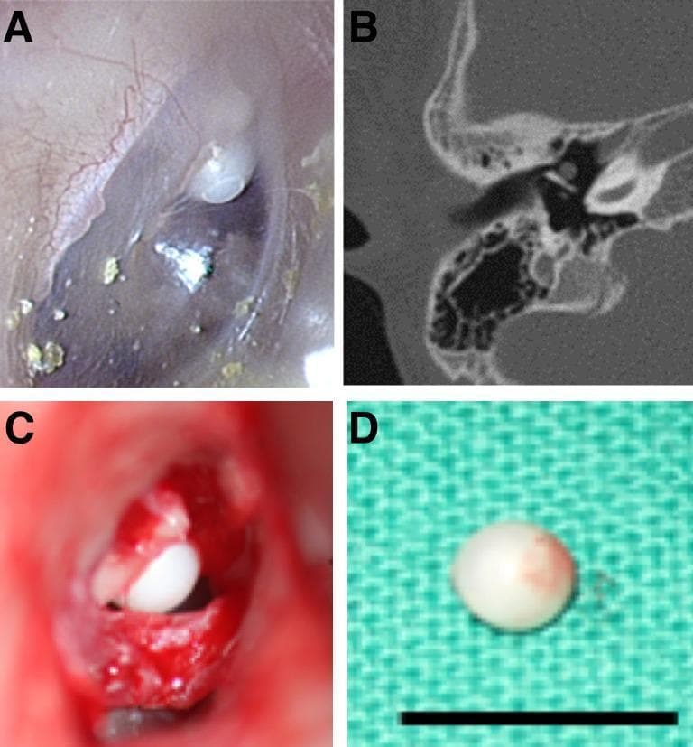 This composite clinical figure illustrates the diagnostic and surgical characteristics of a congenital cholesteatoma in a pediatric patient. Panel A shows an otoscopic view of a pearly, white, spherical mass situated behind an intact, translucent tympanic membrane in the anterior-superior quadrant. Panel B provides an axial non-contrast computed tomography (CT) scan of the temporal bone, identifying a localized soft tissue density within the middle ear cavity without evidence of significant ossicular erosion. Panel C displays the intraoperative finding via a retroauricular approach, revealing the intact spherical keratinous cyst before excision. Panel D shows the gross pathology of the excised specimen, a small pearl-like mass approximately 5mm in diameter (scale bar provided). The figure highlights the classic presentation of congenital cholesteatoma as a 'keratin pearl' in a child with no prior history of ear discharge, surgery, or tympanic membrane perforation. This content is relevant for otolaryngology education regarding middle ear pathologies and surgical management.
