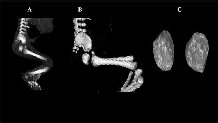 This composite diagnostic image illustrates the skeletal development of a 26-week-old human male fetus through Computed Tomography (CT) and 3D reconstruction. Panel A displays a sagittal CT projection showing the ossified fetal skeleton, highlighting the curved vertebral column, the primary ossification centers of the long bones (femur, tibia, fibula), and the developing foot bones. Panel B provides a 3D reconstruction of the pelvic region in a sagittal view, emphasizing the morphological relationship between the lumbar vertebrae and the developing ilium and ischium. Panel C features a high-resolution 3D volumetric reconstruction of the primary ossification centers of the ischium. These bilateral structures exhibit a rounded, irregular morphology with well-defined contours and a heterogeneous surface texture reflecting varying bone mineral density. The image serves as a reference for fetal osteology and morphometric analysis in prenatal diagnostics and embryology, specifically tracking the progression of primary ossification in the pelvic girdle during the second trimester.