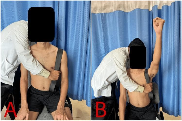 This clinical photograph, divided into two panels (A and B), illustrates a manual therapy technique known as Mulligan's Movement with Mobilization (MWM) for the acromioclavicular (AC) joint. The procedure is performed on a seated patient with a suspected AC joint sprain. A mobilization belt or strap is utilized, passing over the patient's left acromioclavicular joint and anchored around the clinician's hip (out of frame) to apply a sustained inferior-posterior glide to the distal clavicle. Panel A shows the starting position: the clinician, wearing a white coat, stands behind the patient, stabilizing the shoulder girdle and applying the mobilization force. Panel B depicts the dynamic component of the technique, where the patient performs active shoulder flexion (reaching overhead with a clenched fist) while the clinician maintains the therapeutic mobilization glide. This orthopedic intervention is used to restore pain-free range of motion and joint arthrokinematics during shoulder rehabilitation. The images demonstrate the precise hand placement and belt orientation necessary for stabilizing the scapula while mobilizing the AC joint during active movement.