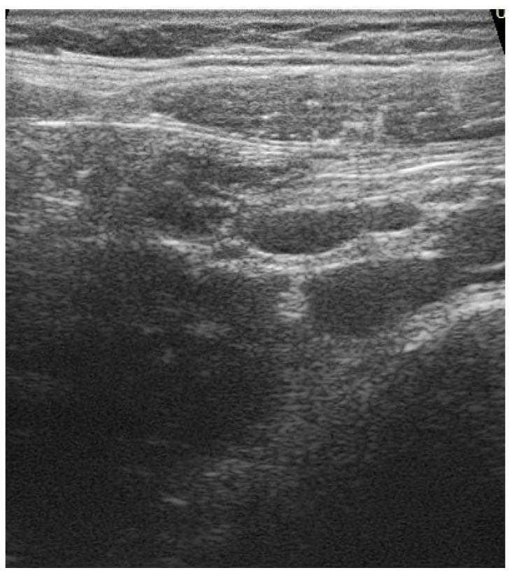 This abdominal ultrasound image demonstrates findings consistent with mesenteric adenitis. The primary diagnostic focus is on multiple enlarged lymph nodes located within the mesentery. These nodes appear as oval to rounded hypoechoic structures with relatively well-defined borders. Surrounding the clustered lymphadenopathy, the mesenteric fat exhibits increased echogenicity (hyperechoic appearance) and a somewhat ill-defined texture, which is a characteristic sonographic sign of localized inflammation or edema. There is a lack of significant fluid collection in the visualized field. The image illustrates the typical reactive appearance of mesenteric lymph nodes in a pediatric or adolescent clinical context, often associated with systemic inflammatory responses or localized gastrointestinal triggers. This diagnostic image serves as a clinical example of adenomesenteritis, showcasing the use of ultrasound in evaluating acute abdominal pain through the identification of lymph node morphology and mesenteric fat changes.