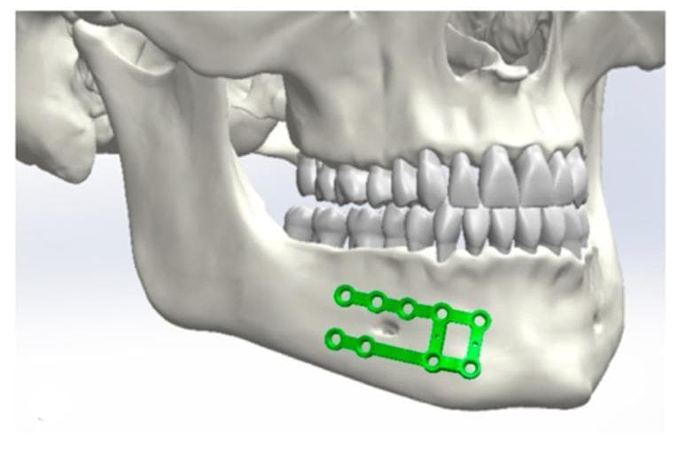 This anatomical diagram depicts a 3D medical illustration of the human skull and mandible, focusing on the surgical planning or placement of an osteosynthesis plate for maxillofacial fracture fixation. The visual highlights a green-colored mini-plate positioned on the right lateral aspect of the mandibular body and symphysis region. The plate features a ladder-like configuration with two parallel horizontal bars connected by vertical segments, containing multiple circular screw holes for internal fixation. It is anatomically contoured to the external cortical surface of the mandible, positioned inferior to the roots of the lower dentition and superior to the mandibular border. The image clearly demonstrates the relationship between the hardware and the surrounding anatomical structures, including the mental foramen and the occlusion of the maxillary and mandibular teeth. This content is representative of oral and maxillofacial surgery training materials, illustrating rigid internal fixation techniques for mandibular fractures.