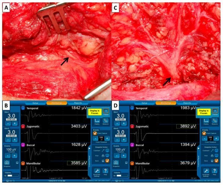 A multi-panel medical image illustrating intraoperative facial nerve monitoring (FNM) during parotid surgery. Panel A is a clinical photograph of the surgical field showing the identification of the facial nerve trunk (arrow) amidst soft tissue and temporo-parotid fascia. Panel C shows the same surgical field following dissection and parotid tumor resection, where the facial nerve trunk and its distal branches are more clearly visualized. Panels B and D display corresponding four-channel electromyography (EMG) monitoring screens. The channels record electrical activity from the temporal, zygomatic, buccal, and marginal mandibular branches. Waveforms and peak amplitudes (measured in µV) are shown for each branch: Panel B (F1) represents baseline signals pre-dissection, and Panel D (F2) represents signals post-dissection. This comparison is used to evaluate nerve integrity and function throughout the procedure. The interface highlights stimulus intensity (3.0 mA), event thresholds (100 µV), and real-time amplitude variations indicative of possible neuropraxia or successful nerve preservation.
