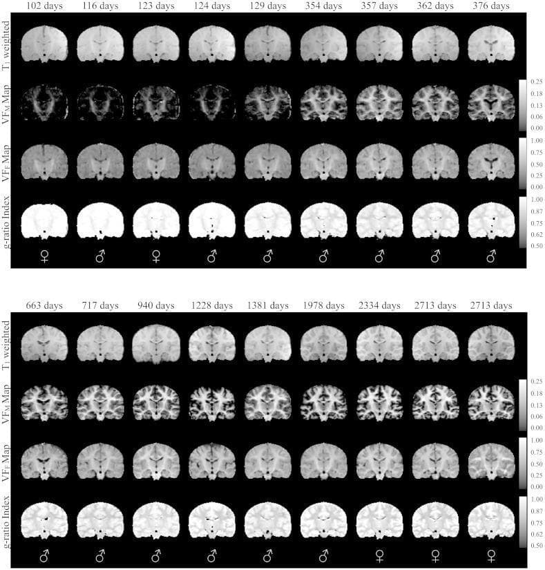 This Comparison Chart displays sequential coronal diagnostic images of infant brain development across a timeline ranging from 102 to 2713 days. The visualization is organized into four distinct imaging modalities per subject: T1-weighted MRI, Volume Fraction of Myelin (VFM) maps, Volume Fraction of Fluid (VFF) maps, and Myelin g-ratio index maps. The T1-weighted images demonstrate a progressive increase in gray-white matter contrast and signal intensity in the white matter, indicative of normative neurodevelopment. The VFM maps show a chronological increase in signal within white matter tracts, signifying active myelination. In contrast, the g-ratio index maps—representing the ratio of the inner to the outer diameter of the myelin sheath—show a decrease in values (transitioning from lighter to darker intensities) as the subjects age, reflecting the maturation and thickening of the myelin sheath. Clinical significance focuses on characterizing the spatio-temporal patterns of infant brain maturation, starting from central structures like the internal capsule and progressing toward the cortical lobes. This material serves as a reference for pediatric neuroradiology and developmental neuroscience.