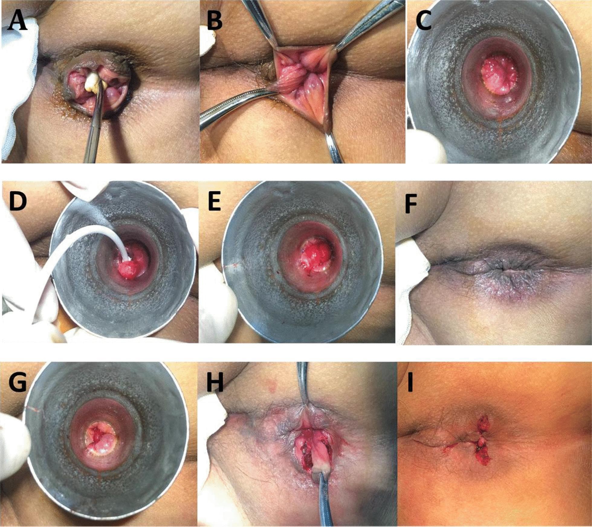 This nine-panel clinical photographic series (A-I) documents a combined surgical procedure for hemorrhoids: the Ruiyun procedure for hemorrhoids (RPH) and a simplified Milligan-Morgan hemorrhoidectomy (sMMH) with dentate line-sparing. Panel A displays circumferential prolapsed hemorrhoids with associated skin tags. Panels B and C illustrate the pre-operative evaluation of the anal canal using forceps and a horn-shaped anoscope to identify internal hemorrhoids and loose mucosa above the dentate line. Panels D and E demonstrate the RPH technique, showing the suctioning of internal hemorrhoidal tissue and subsequent ligation with an elastic suture ring to restrict blood flow. Panel F shows the immediate improvement in mucosal prolapse following ligation. Panels G through I depict the sMMH phase targeting external components below the dentate line: Panel G shows the local anatomy via anoscope, Panel H captures a radial fusiform incision and stripping of the subcutaneous vascular cluster forming an inverted 'V' shape, and Panel I shows the final surgical site after clamping, ligation, and excision of the hemorrhoidal tissue.