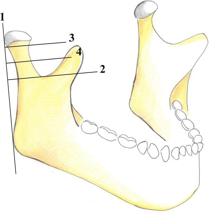 This medical anatomical diagram illustrates the AO Foundation's classification system for mandibular condyle fractures. The illustration depicts a lateral view of a human mandible, focusing on the condylar process, coronoid process, sigmoid notch, and mandibular angle. Four reference lines are utilized to categorize fracture locations: Line 1 is a vertical tangent to the posterior border of the condylar head and mandibular angle; Line 2 is horizontal and perpendicular to Line 1, passing through the deepest point of the sigmoid notch; Line 3 is parallel to Line 2, passing through the inferior margin of the condylar head; and Line 4 is situated equidistant between Lines 2 and 3. In this classification, fractures occurring above Line 3 are 'condylar head' fractures. Fractures between Line 3 and Line 4 are classified as 'high-neck' fractures, while those between Line 4 and Line 2 are 'low-neck' fractures. This standardized mapping aids oral and maxillofacial surgeons in diagnostic reporting and surgical planning for condylar injuries.