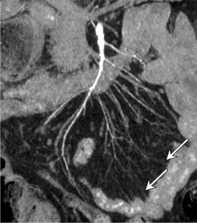 This diagnostic image is a coronal maximum intensity projection (MIP) MDCT reconstruction focusing on the abdominal arterial vasculature. The image demonstrates the superior mesenteric artery (SMA) and its distal branches in a patient with non-occlusive mesenteric ischemia (NOMI) secondary to hemorrhagic shock and vasopressor (VCA) support. Key findings include severe, diffuse vasoconstriction and luminal irregularity throughout the main trunk of the SMA. The secondary and tertiary branches, including the vasa recta, exhibit significant attenuation and a 'string-of-beads' or pruned appearance. Specifically, the white arrows highlight severe spasm of the distal mesenteric arcades, characterized by a marked reduction in vessel caliber and abrupt termination, indicating severely compromised peripheral vascular perfusion to the small bowel. This imaging represents a classic radiological presentation of drug-induced or shock-related mesenteric vasospasm, which clinically correlated with segmental ileal necrosis in this case.