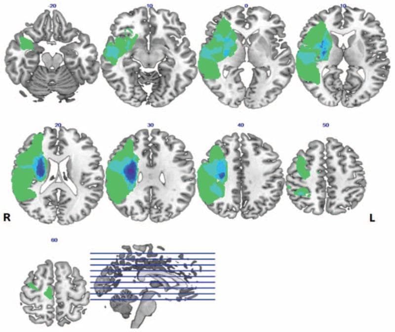 This diagnostic image displays a series of neuroanatomical maps showing lesion distribution across a cohort of stroke patients with left hemiplegia. The visual data is presented through nine axial slices and one sagittal reference image, utilizing color-coded heat maps superimposed on a standard brain template. The color gradient represents lesion frequency, with green indicating low overlap and darker blue indicating areas of high lesion density across the patient group. The maps demonstrate that lesions are primarily lateralized to the right hemisphere, with the most significant overlap concentrated in the internal capsule and adjacent deep subcortical structures (notably visible in axial slices at coordinates 20 and 30). The distribution extends from the level above the cerebellum through various cortical layers (coordinates -20 to 60). Anatomical landmarks, including the lateral ventricles and basal ganglia, provide context for the subcortical localization of the ischemic damage. This visualization is used in neuroimaging research to correlate specific structural damage within motor pathways to clinical manifestations like hemiplegia.