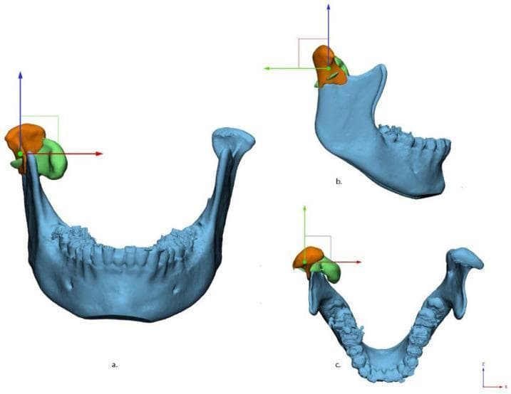 This medical visualization presents a three-dimensional (3D) digital reconstruction of a human mandible with a condylar fracture, segmented using medical modeling software. The image displays the fracture alignment in three standard anatomical views: (a) anterior-posterior, (b) medio-lateral (sagittal profile), and (c) cranial-caudal (superior axial view). The mandible is shown in light blue, while the fractured condylar fragments are color-coded in orange and green to indicate displacement and rotation relative to the intact mandibular ramus. A standardized 3D Cartesian coordinate system is overlaid on the fractured condyle: the X-axis (red) represents horizontal displacement, the Y-axis (green) represents vertical/coronal alignment, and the Z-axis (blue) represents depth or axial rotation. This diagram is designed for oral and maxillofacial surgery education, illustrating the complex spatial deviation and 3D displacement vectors (measured in millimeters and degrees) used for virtual surgical planning and anatomical reduction of condylar fractures.
