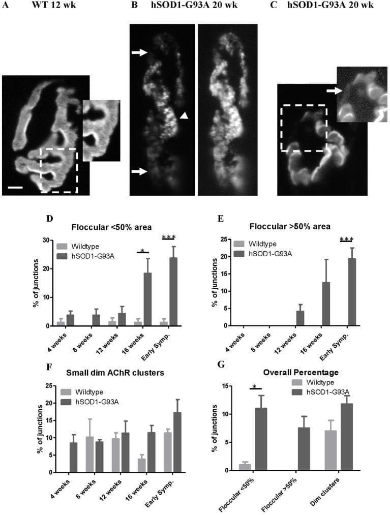 This composite educational graphic illustrates the structural degradation of neuromuscular junctions (NMJs) in an hSOD1-G93A mouse model of Amyotrophic Lateral Sclerosis (ALS). (A) Fluorescence microscopy of a 12-week wild-type NMJ shows a normal 'pretzel-like' acetylcholine receptor (AChR) distribution with crisp borders and a uniform fingerprint-like pattern. (B-C) Corresponding images from 20-week symptomatic hSOD1-G93A mice reveal pathological remodeling, characterized by a granular/floccular AChR appearance (arrowheads), overall labeling dimness (arrows), and fragmented, dim extrajunctional clusters indicating receptor loss or disorganized insertion. Panels D-G present longitudinal quantitative data via bar charts. They demonstrate that while wild-type mice maintain stable NMJ morphology, hSOD1-G93A mice exhibit a significant, age-dependent increase in disrupted AChR patterns. Key findings show that floccular distributions exceeding 50% of the junctional area emerge by 12 weeks and increase sharply by early symptomatic stages (16-20 weeks), correlating structural NMJ decay with disease progression and motor symptom onset.