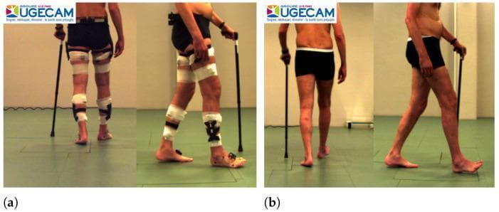 This clinical photograph comparison demonstrates the functional outcome of Botulinum Toxin Type A (BTX-A) treatment for lower limb spasticity. Panel (a) shows the subject 'before treatment' from posterior and lateral views. The subject exhibits significant motor impairment requiring a walking cane and bilateral assistive devices, including wraps and bracing on the thighs and lower legs. The gait is characterized by a forward-leaning trunk, uneven trunk alignment, and abnormal foot placement, with the left foot notably in a position of plantar flexion (equinus deformity). Panel (b) shows the same subject 'after treatment.' The subject is walking without the previous lower limb braces or wraps. The posture is visibly more upright and symmetric, with improved trunk-pelvis alignment. Gait analysis reveals a more natural and fluid stride, characterized by improved knee extension and better ankle dorsiflexion during the swing and initial contact phases. While a cane is still held for balance, the dependency on physical support is reduced, illustrating the efficacy of BTX-A in managing spasticity in conditions like Cerebral Palsy, Multiple Sclerosis, or post-stroke hemiparesis.