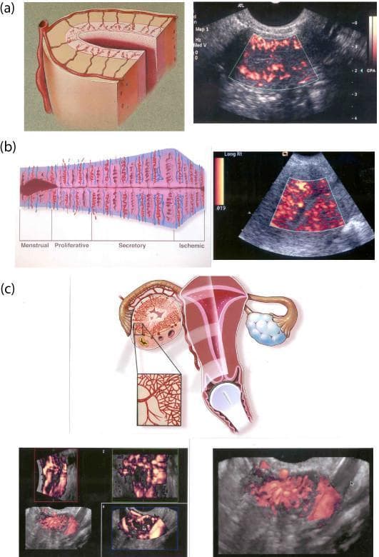 This composite educational resource compares 2D and 3D transvaginal color Doppler sonography (TV-CDS) for evaluating pelvic vascularity. (a) A cross-sectional anatomical diagram and 2D TV-CDS image highlight the uterine vascular hierarchy during the follicular phase, depicting arcuate, radial, and spiral vessels. (b) A timeline diagram illustrates endometrial vascular changes across the menstrual cycle phases: Menstrual, Proliferative, Secretory, and Ischemic. This is paired with a 2D TV-CDS showing the characteristic increase in spiral vessel density during the luteal phase. (c) The bottom section focuses on the corpus luteum, featuring a diagram of the female reproductive system with a magnified view of ovarian vascularization. Below this, multiplanar 3D TV-CDS images (longitudinal, axial, and coronal planes) and a high-definition 3D reconstruction demonstrate the pathognomonic vascular 'wreath'—a dense circumferential ring of blood vessels surrounding the functioning corpus luteum. This content illustrates key gynecological sonography concepts, including the cyclical nature of endometrial perfusion and the advanced spatial assessment afforded by 3D Doppler imaging for ovarian structures.