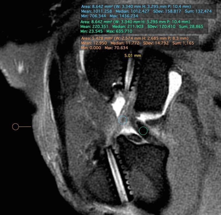 A diagnostic MRI image of a sagittal oblique PD-STIR section of a stifle (knee) joint, illustrating the methodology for calculating the signal-to-noise quotient (SNQ) to assess graft maturation. The image displays three specific Regions of Interest (ROIs): a blue circular ROI positioned over the intra-articular ligament graft, a green circular ROI placed over the posterior cruciate ligament (PCL) to serve as an internal reference, and an orange circular ROI located cranial to the skin edge to measure background signal intensity. Quantitative data overlays at the top of the image provide detailed pixel intensity statistics for each ROI, including area (mm²), mean, median, standard deviation, and range. This radiological technique is used in orthopedic research to objectively quantify the signal intensity of an ACL or similar graft relative to healthy ligamentous tissue and background noise, where a lower SNQ value indicates more advanced ligamentization and graft healing.