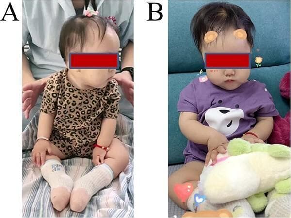 Two-panel clinical photograph (A and B) demonstrating the gross motor development and therapeutic progress of a pediatric patient with Spinal Muscular Atrophy (SMA) post-risdiplam treatment. Image A shows the infant at 3 months post-treatment, achieving the milestone of sitting for approximately 5 seconds without direct assistance, although caregiver hands remain in close proximity to monitor trunk stability. The patient exhibits characteristic features of SMA-related hypotonia but shows improving axial strength. Image B shows the same patient 7 months post-treatment, demonstrating significant clinical improvement in postural control and fine motor skills. The infant is now sitting independently and stably on a couch for over 2 minutes, actively engaging in play with a plush toy. This transition illustrates the functional efficacy of SMN2-directed therapy in improving neuromuscular scores (CHOP-INTEND) and achieving developmental milestones such as unassisted sitting and manual exploration of the environment.