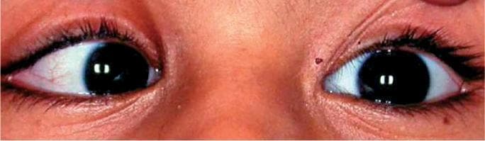 This clinical photograph shows a close-up view of a child's eyes demonstrating ocular misalignment. The patient exhibits right esotropia, characterized by a visible inward deviation of the right eye toward the nose (nasal deviation) while the left eye maintains primary gaze fixation. The pupils are equally round and black with visible light reflections centrally located, suggesting symmetric pupillary size. In the left eye, mild injection of the sclera is noted with visible fine blood vessels. The surrounding periorbital skin is intact, and a small, pigmented nevus is visible near the medial canthus of the right eye. This image serves as a clinical example of strabismus (squint) in a pediatric patient, emphasizing the lack of parallel ocular alignment. It is used in educational contexts to teach the visual identification of ocular deviations and the importance of screening for vision conditions such as amblyopia that may result from untreated strabismus.