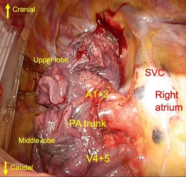 This clinical intraoperative photograph displays a forward surgical view of the right pulmonary hilum during a thoracic procedure, likely a right upper lobectomy. The image highlights the anatomical relationships between lung parenchyma and hilar vascular structures with directional markers indicating cranial and caudal orientations. The right upper lobe and middle lobe are visible, with the pulmonary artery (PA) trunk positioned between them. Notable vascular anatomy includes the superior vena cava (SVC) and right atrium, appearing as smooth, glistening, reddish-yellow structures lateral to the lung tissue. Specific segmental vessels are annotated: A1+3 is situated superior to the PA trunk, while V4+5 is located caudally. The image demonstrates a surgical scenario where the segmental veins V1 and V2+3 are not visible in their standard anterior hilar position, with the main pulmonary artery running anteriorly to them. This visual serves to illustrate anatomical variations relevant to safe hilar dissection and vascular control in thoracic surgery.