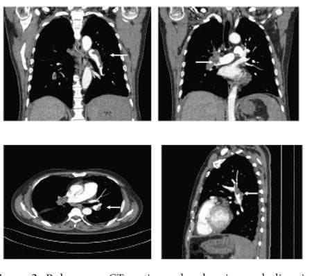 This diagnostic image set consists of four pulmonary CT angiography (CTPA) views, including coronal, axial, and sagittal planes. The primary finding is the presence of multiple, irregular intravascular filling defects within the bilateral pulmonary arteries and their segmental branches, indicated by white arrows. These defects represent acute pulmonary emboli causing varying degrees of luminal obstruction. In the coronal views, the emboli are visible in the proximal pulmonary vasculature, while the axial slice highlights a defect in the left pulmonary arterial tree. Secondary findings include small bilateral pleural effusions, visible as fluid accumulation in the dependent pleural spaces. The lung parenchyma shows localized areas of increased density/haziness. These images are clinically significant for the diagnosis of pulmonary embolism and associated secondary thoracic complications in a patient presenting with respiratory distress.