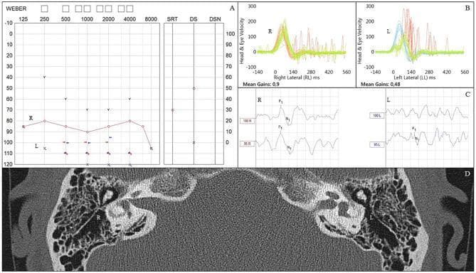 A composite medical diagnostic graphic illustrating audiovestibular findings following childhood bacterial meningitis. (A) Pure tone audiogram shows right-sided profound sensorineural hearing loss and left-sided anacusis. (B) Video Head Impulse Test (vHIT) results display a normal vestibulo-ocular reflex (VOR) gain of 0.9 on the right, contrasted with an abnormally low gain of 0.48 on the left, characterized by prominent covert and overt refixation saccades indicating vestibular dysfunction. (C) Cervical Vestibular Evoked Myogenic Potentials (cVEMPs) show measurable P1-N1 waveforms on the right side, while responses are absent on the left. (D) Axial CT scan of the temporal bones demonstrates pathological ossification (labyrinthitis ossificans) within the left lateral semicircular canal, while the right vestibular apparatus maintains normal patency and configuration. This educational series highlights the correlation between clinical vestibular testing and radiological evidence of labyrinthine damage post-meningitis.