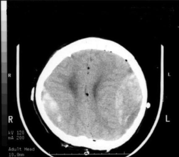 This diagnostic image is an axial non-contrast CT scan of the brain, demonstrating acute bilateral epidural hematomas (EDHs). In the frontoparietal regions, there are biconvex (lenticular) hyperdense extra-axial collections located adjacent to the inner table of the skull. The right-sided hematoma shows significant density, while the left-sided collection is also prominent, causing mild mass effect on the underlying brain parenchyma. Small punctate hypodensities are visible within the intracranial space, consistent with pneumocephalus (small air bubbles), which are typical in a postoperative clinical context following neurosurgical procedures like tumor resection. The lateral ventricles appear largely symmetric without significant midline shift or ventricular effacement at this level. This case illustrates a rare postoperative complication involving remote bilateral EDHs after surgical intervention for a pineal region tumor. The image is a critical educational resource for neurosurgery and radiology trainees to recognize acute intracranial hemorrhage and the importance of postoperative CT monitoring.