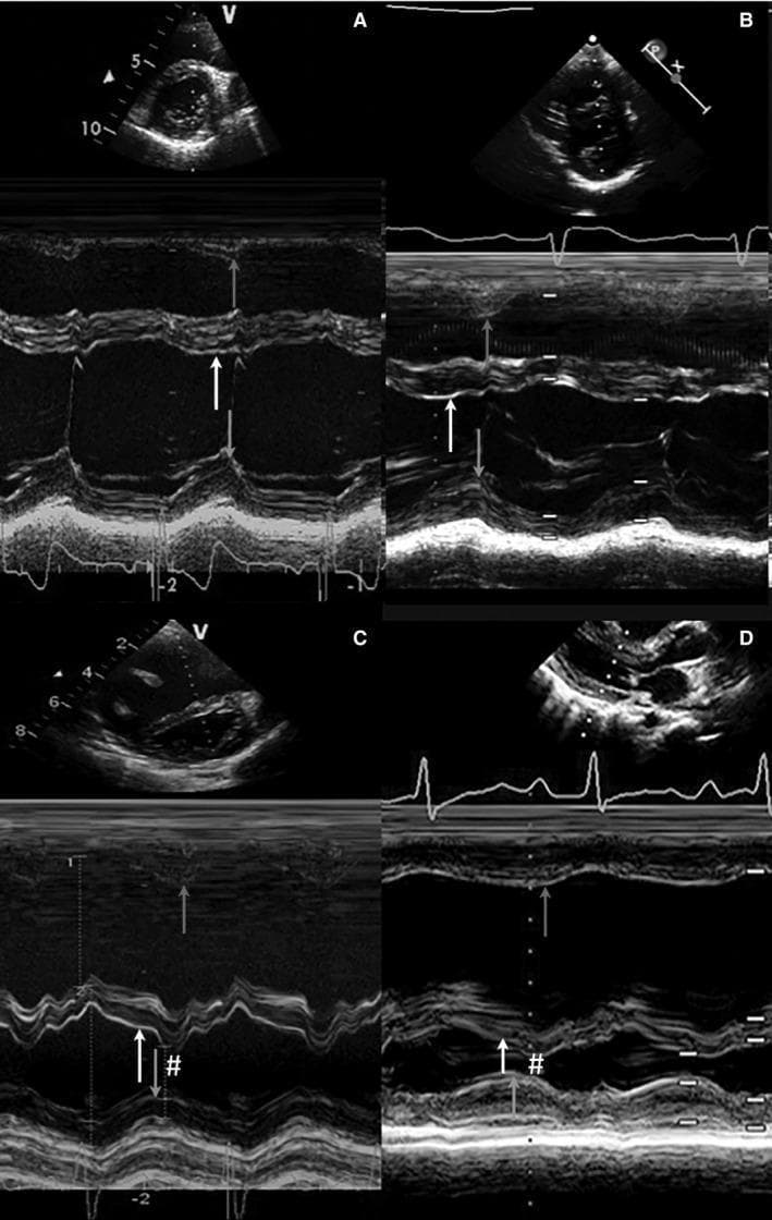 This composite diagnostic image displays four M-mode echocardiography panels (A, B, C, and D) used to evaluate interventricular septal (IVS) kinetics across different cardiac conditions. Each panel consists of a two-dimensional sector orientation image (top) and an M-mode tracing (bottom) showing the depth of cardiac structures over time. The tracings highlight the motion of the right ventricular free wall (RVFW), the IVS, and the left ventricular posterior wall (LVPW).
Panel A represents a healthy control with normal, coordinated septal motion. Panel B shows pulmonary stenosis (PS), exhibiting delayed onset of contraction but maintaining relatively coordinated free wall motion. Panels C and D illustrate idiopathic pulmonary arterial hypertension (iPAH), characterized by significant mechanical discoordination. These pathological examples feature abnormal septal displacement marked by a '#' symbol, indicating paradoxical or leftward displacement toward the LVPW during early diastole and late systole. Arrows indicate the timing to peak radial motion, demonstrating the prolonged systolic contraction and delayed relaxation phases typical of right ventricular pressure overload. This visual comparison serves as an educational tool for identifying ventricular dyssynchrony and septal flattening in pulmonary hypertensive heart disease.