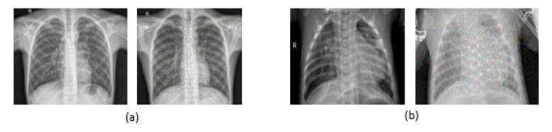 This diagnostic image comparison features four posterior-anterior (PA) chest X-ray radiographs organized into two groups for educational analysis of pneumonia. Group (a) displays normal chest X-rays, characterized by clear lung fields, distinct costophrenic angles, and visible bronchovascular markings. Group (b) illustrates pneumonia-affected lungs, demonstrating hallmark pathological signs including increased haziness, pulmonary infiltrates, and areas of consolidation that obscure normal lung parenchymal detail and cardiac borders. Each group includes one original radiograph and one version processed with a 'Deep Dream' filter, a computer vision technique used here to accentuate texture and pattern recognition for deep learning model training. The filtered pneumonia image in group (b) highlights abnormal mesh-like opacities and parenchymal irregularities. This comparison serves as educational material for medical imaging informatics and radiology, demonstrating the visual differences between healthy pulmonary tissue and inflammatory consolidation associated with infectious pneumonia in both raw and processed data formats.