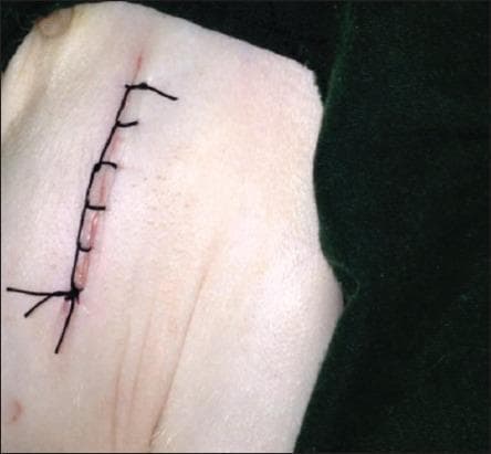 This clinical photograph displays a primary surgical closure of a skin incision. The incision is closed using a Ford interlocking suture pattern (also known as a blanket stitch), characterized by its continuous, self-locking loops that provide superior apposition and security. The suture material is a black, non-absorbable synthetic filament, likely silk or nylon. The wound edges are closely approximated, with the interlocking segments crossing the incision line at regular intervals to distribute tension evenly. The surrounding skin is pale with visible natural skin folds and minor erythema along the immediate incision line. This visual demonstrates a common surgical technique used in wound management and minor surgical procedures to achieve secure skin closure while saving time compared to simple interrupted sutures. The focus is on the geometric regularity of the interlocking loops and the clinical appearance of a fresh postoperative suture line.