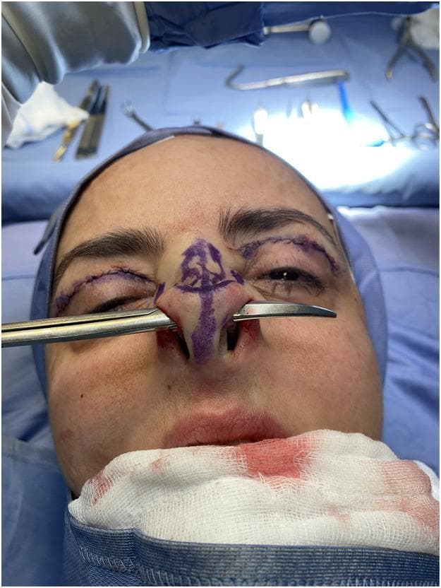 This intraoperative clinical photograph captures a surgical maneuver during a closed rhinoplasty and concurrent blepharoplasty. The primary focus is the intraoperative assessment of nasal symmetry. Straight Metzenbaum scissors are inserted through bilateral transcartilaginous incisions, passing over the residual lower lateral (alar) cartilages. This technique is used to evaluate the symmetry and height of the cartilaginous arches following the resection of their cephalic portions. Purple surgical markings are visible on the nasal dorsum and tip, outlining the pre-operative plan. Additionally, the patient exhibits fresh sutured incisions on the upper eyelids consistent with a blepharoplasty procedure. The surgical field includes sterile blue drapes, a blood-stained gauze at the chin, and various surgical instruments in the background. This image serves as an educational tool for plastic surgery trainees to understand intraoperative quality control and the anatomical landmarks involved in refining the nasal tip and maintaining structural symmetry.