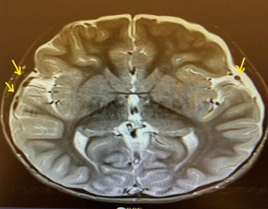 This diagnostic image is an axial MRI of the brain, specifically a T2-weighted sequence where cerebrospinal fluid (CSF) appears bright (hyperintense). The image demonstrates the cerebral hemispheres with visible cortical gyri and sulci, the lateral ventricles, and the third ventricle. Yellow arrows highlight several small, discrete, hypointense (dark) pockets located within the subdural space, particularly adjacent to the frontal and temporal lobes. These localized fluid collections are clinically significant as they represent subdural effusions or empyemas (pockets of pus) in a patient with meningitis. The brain parenchyma shows some architectural crowding, potentially indicative of mild cerebral edema. This image is used to educate clinicians on the neurological complications of bacterial meningitis, such as those caused by Haemophilus influenzae, and the importance of monitoring for intracranial fluid collections that may require neurosurgical intervention.