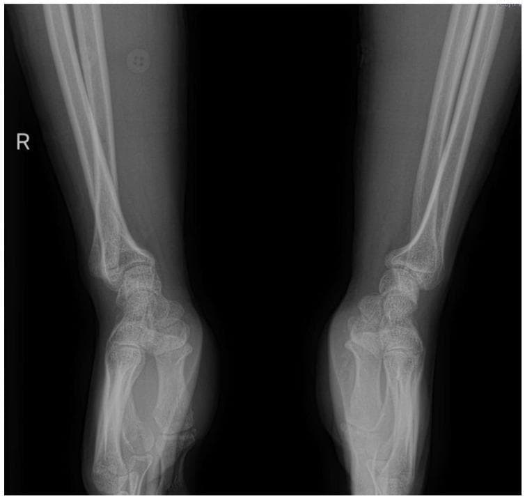 This diagnostic image is a comparative X-ray radiography (lateral view) of the right and left wrists. The right wrist exhibits a clear pathology characterized by a Galeazzi-type injury pattern. Key findings include a fracture of the distal radius with associated shortening and dorsal angulation. Crucially, there is a prominent dorsal dislocation of the ulnar head at the distal radioulnar joint (DRUJ), evidenced by the increased radioulnar distance and displacement relative to the carpal bones. In contrast, the left wrist (shown for comparison) displays normal anatomical alignment of the radius and ulna, with an intact DRUJ and congruent articulation. The image illustrates the clinical significance of assessing the entire forearm unit, as distal radius fractures can frequently be associated with occult or overt DRUJ instability. This visual is typical for orthopedic education focusing on wrist trauma, fracture classification, and joint instability mechanisms.