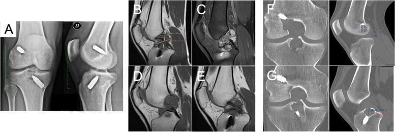 Multi-modal diagnostic imaging of a knee joint post-ACL reconstruction with a synthetic LARS graft, demonstrating significant osteolysis and a pseudo-myxoid mass. (A) Anteroposterior and lateral X-rays show radiopaque fixation screws with marked widening of the femoral and tibial tunnels and increased radiolucency in the intercondylar eminence, indicating peri-tunnel bone resorption. (B-E) Sagittal MRI views demonstrate a large, well-defined mass occupying the intercondylar notch. The lesion is predominantly hypointense on T1-weighted sequences (B, D) and displays heterogeneous hyperintensity on STIR sequences (C, E), consistent with a multicystic, fluid-filled pseudo-myxoid mass that lacks a healthy ACL graft signal. (F-G) Coronal and sagittal CT scans highlight the precise morphology of the grade 3 osteolytic cavities, revealing extensive loss of subchondral and cancellous bone surrounding the femoral (F) and tibial (G) tunnels. This imaging series illustrates a severe inflammatory and osteolytic complication following synthetic ligament implantation, characterized by tunnel enlargement and intra-articular cystic mass formation.