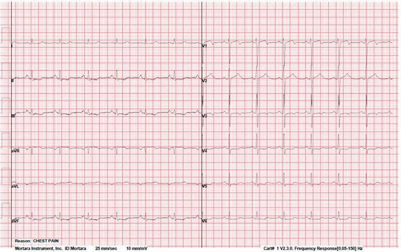 A 12-lead electrocardiogram (ECG) recorded at standard settings (25 mm/sec, 10 mm/mV) showing a normal sinus rhythm with significant ischemia-related ST-segment changes. The tracing demonstrates mild ST-segment depression in the inferior leads (II, III, and aVF) and across the precordial leads (V3 through V6). The R-wave progression in the precordial leads (V1-V6) is within normal limits, with the R-wave amplitude increasing appropriately from right to left chest leads. T-waves appear predominantly upright in the leads where ST depression is present. These findings are clinically significant for myocardial ischemia, particularly in a patient presenting with chest pain, and may indicate underlying coronary artery disease or spontaneous coronary artery dissection (SCAD). The ECG provides a baseline for evaluating evolutionary changes post-intervention, such as after percutaneous coronary intervention (PCI).