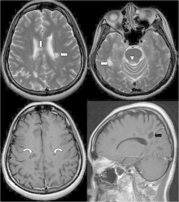 This composite diagnostic image presents Brain Magnetic Resonance Imaging (MRI) findings diagnostic of Multiple Sclerosis (MS). Top Row: Axial T2-weighted images demonstrating multiple hyperintense foci located in the bilateral periventricular white matter, the body of the corpus callosum (arrows), and the periaqueductal grey matter (arrowhead). Bottom Left: Axial T1-weighted image with gadolinium contrast showing distinctive ring-enhancing lesions (curved arrows), indicating active inflammatory demyelination and blood-brain barrier breakdown. Bottom Right: Sagittal T1-weighted image highlighting MS plaques oriented perpendicularly to the callososeptal interface. This characteristic morphology, known as 'Dawson’s fingers,' follows the distribution of the medullary veins. The combination of these findings, particularly the presence of enhancing and non-enhancing lesions, supports the McDonald criteria for dissemination in space and time. This image is an essential educational resource for neuroradiology and neurology, illustrating classic radiographic signatures of demyelinating disease in the central nervous system.