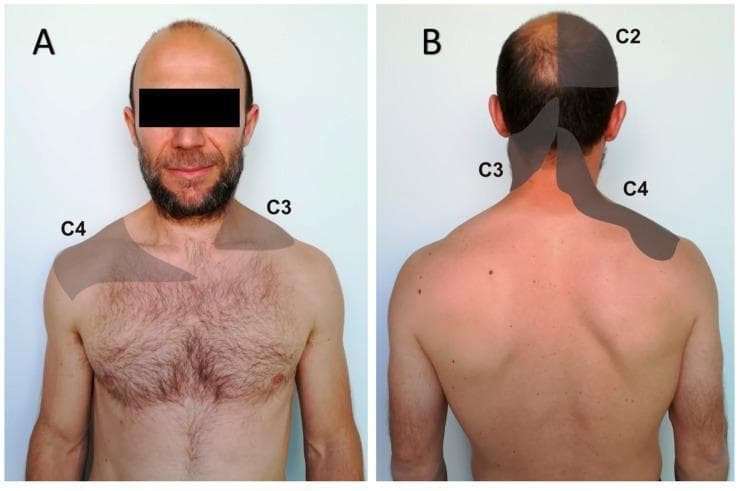 This clinical photograph consists of two panels illustrating the patterns of visceral referred pain mapped onto specific cervical dermatomes. Image A provides an anterior view of a male torso with shaded regions indicating referred pain in the C3 and C4 dermatome distributions. The C3 region is depicted over the right clavicular and lower neck area, while the C4 region is shown on the left shoulder and upper pectoral area. Image B provides a posterior view, highlighting the C2, C3, and C4 dermatomes. C2 is mapped over the right occipital region of the scalp; C3 is shown along the left posterior neck; and C4 is mapped across the right supraclavicular and superior scapular region. This anatomical illustration is used for clinical education regarding the recognition of referred pain originating from internal organs, such as the diaphragm, liver, or heart, which can manifest as somatic discomfort in the neck and upper quadrant. The content is suitable for medical education in fields such as neurology, physical therapy, and internal medicine to assist in the differential diagnosis of visceral versus somatic pain sources.