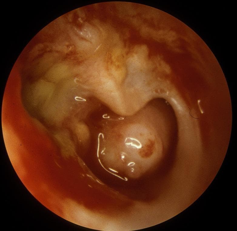 This endoscopic clinical photograph depicts the right tympanic membrane and middle ear cavity, demonstrating hallmark features of Chronic Suppurative Otitis Media (CSOM). A large subtotal perforation is visible, through which the structures of the middle ear are exposed. The middle ear mucosa appears erythematous and thickened, indicative of chronic inflammation. There is evidence of mucoid drainage, presenting as a viscous, translucent fluid within the cavity. Crucially, the long process of the incus shows significant erosion, a common sequela of long-standing inflammatory processes in the middle ear. The remaining tympanic membrane remnants appear thickened and opaque. This image serves as a classic educational example of middle ear pathology and the destructive potential of chronic infectious processes on the ossicular chain.