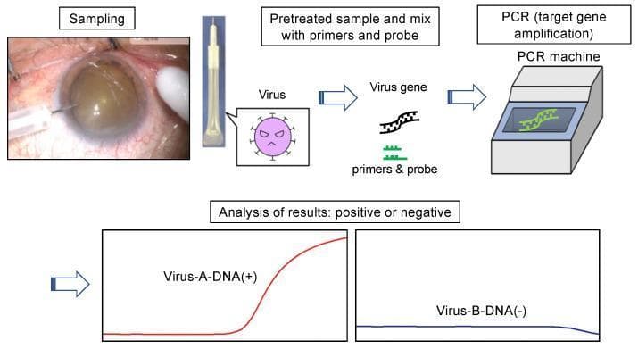 This educational infographic illustrates the diagnostic workflow for Polymerase Chain Reaction (PCR) testing of ocular samples, specifically in the context of infectious uveitis or endophthalmitis. The diagram begins with an 'intraoperative image' showing 'Sampling,' where a fine-gauge needle is used to perform an anterior chamber tap to collect aqueous humor from the eye. The process flows through 'Pretreated sample' preparation, where the viral gene is extracted and mixed with specific primers and probes. This mixture is then processed in a 'PCR machine' for target gene amplification. The final stage involves 'Analysis of results' shown via comparative amplification curves. A positive result (Virus-A-DNA(+)) is depicted by a red sigmoidal curve indicating logarithmic amplification, while a negative result (Virus-B-DNA(-)) is shown as a flat blue baseline. This visual highlights the clinical application of molecular diagnostics in ophthalmology for rapid pathogen identification.