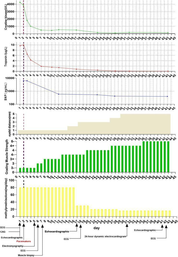 A multi-panel timeline chart illustrating the clinical and biochemical progression of a patient with immune-checkpoint inhibitor (ICI)-induced multiorgan failure, including myocarditis and myasthenia gravis. The top three line graphs track cardiac and muscle biomarkers: Creatine Kinase (U/L), Troponin I (ug/L), and Brain Natriuretic Peptide (BNP, pg/mL). All markers show a sharp peak followed by a rapid decline toward normalization following the initiation of treatment on day 1 (marked by a vertical dashed line). Middle panels consist of a shaded area graph showing an increase in eyelid distance (mm) from 0 to 4mm and a bar chart demonstrating a steady improvement in Grading Muscle Strength from 2 to 5+. The bottom bar chart detail the methylprednisolone dosage (mg/day), starting at 80 mg/day with a gradual taper after day 17. A timeline footer indicates the timing of diagnostic interventions, including electrocardiography (ECG), coronary angiography (CAG), echocardiography, muscle biopsy, electromyography, and pacemaker implantation. This visual data correlates high-dose corticosteroid therapy with the resolution of biochemical markers and clinical improvement in myopathic and cardiac symptoms.