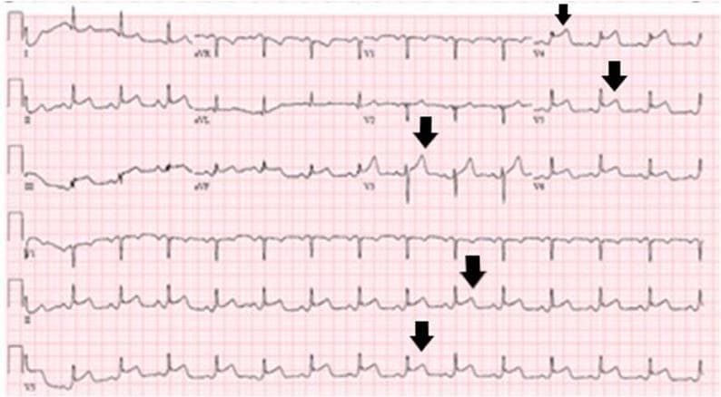 This diagnostic image is a 12-lead electrocardiogram (ECG) demonstrating an acute ST-elevation myocardial infarction (STEMI) localized to the inferolateral territory. The tracing exhibits significant ST-segment elevation above the isoelectric line, particularly prominent in the lateral precordial leads (V4-V6) and inferior leads, as highlighted by the black arrows. The ST segments show an upwardly convex morphology, merging with tall, hyperacute T waves. Reciprocal ST-segment depression is visible in the augmented limb lead aVL and lead I, which is characteristic of inferior wall involvement. The QRS complexes maintain a relatively narrow morphology without evidence of pathological Q waves, suggesting an acute or hyperacute stage of coronary artery occlusion. This ECG is a critical educational resource for cardiovascular medicine, illustrating the visual criteria for STEMI diagnosis, including the significance of lead distribution in identifying the anatomical area of myocardial injury and the presence of reciprocal changes.