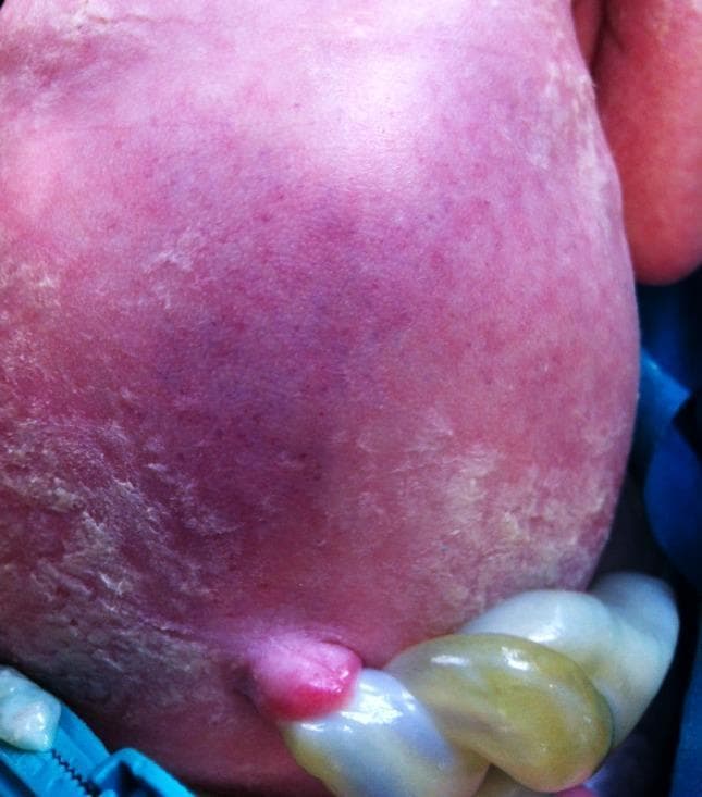 This clinical photograph shows a close-up view of a newborn infant's abdomen, specifically highlighting the periumbilical region. The image demonstrates Cullen's sign, characterized by periumbilical ecchymosis appearing as a diffuse, bluish-purple discoloration on the pinkish-red abdominal skin. The surrounding skin exhibits a slightly rough texture with areas of fine desquamation or peeling. The umbilical cord is visible at the lower portion of the frame, showing a healthy, moist, and gelatinous (Wharton's jelly) appearance with a twisted, braided structure and characteristic white, pale blue, and yellowish-green hues. The umbilical stump itself is erythematous and slightly edematous. In a clinical context, Cullen's sign in a neonate or adult is a significant diagnostic finding indicating retroperitoneal hemorrhage, often associated with conditions such as acute pancreatitis, ruptured ectopic pregnancy, or, in newborns, potential abdominal trauma or visceral hemorrhage. This image serves as a high-fidelity educational resource for identifying classic dermatologic signs of internal bleeding.
