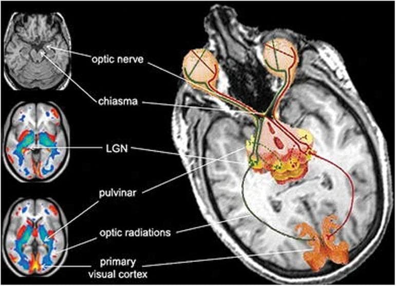 This composite diagnostic and pathophysiology diagram illustrates the anatomical structures and neuroplastic changes of the human visual pathway, specifically focusing on atrophy in congenitally blind individuals. The primary image is a transversal T1-weighted MRI slice with a superimposed schematic of the visual system. Key structures are labeled: the optic nerves originating from the globes, the optic chiasm, the lateral geniculate nucleus (LGN) and pulvinar of the thalamus, the optic radiations (geniculocalcarine tract), and the primary visual cortex in the occipital lobe. Three smaller axial brain scans on the left provide additional context. The top scan is a structural MRI identifying the optic nerve and chiasm. The middle and bottom scans are color-coded statistical parametric maps (likely VBM or PET) showing regional brain volume differences. Blue shading indicates areas of significant gray matter volume reduction (atrophy) in the thalamic relays and visual cortex, while red/yellow highlights show areas of metabolic or structural divergence. This visual is designed for advanced medical education regarding neuroanatomy and the effects of long-term sensory deprivation on the central nervous system.