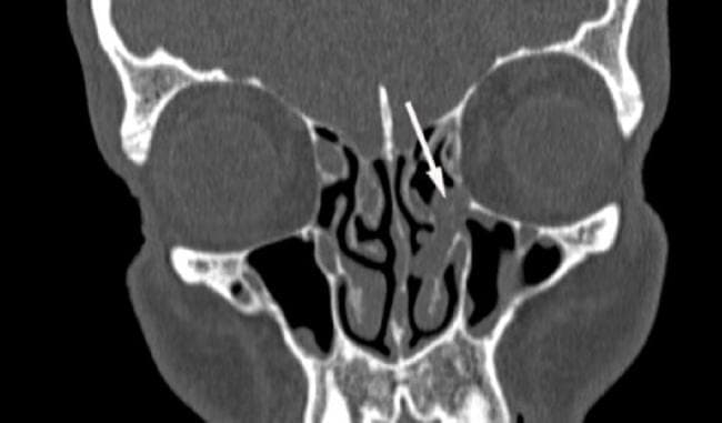This diagnostic image is a coronal CT scan of the paranasal sinuses focusing on the sinonasal anatomy in the context of pre-transplant screening. The image displays the frontal sinuses, ethmoid air cells, maxillary sinuses, and the nasal cavity with its turbinates. A white arrow points to a distinct soft tissue density mass, identified as a nasal polyp, located within the left osteomeatal complex (right side of the image). This mass is causing mechanical obstruction of the drainage pathway. The contralateral (right) osteomeatal complex remains patent and air-filled. The surrounding bony structures, including the orbital floors and nasal septum, appear intact. Such imaging is critical in hematology-oncology patients, specifically those with acute myeloid leukemia undergoing hematopoietic stem cell transplantation, to identify and manage potential foci of infection or obstructive sinonasal disease prior to immunosuppression.