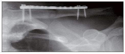 Postoperative anteroposterior (AP) X-ray radiography of the shoulder region, specifically focusing on the clavicle. The image demonstrates surgical management of a middle-third clavicle fracture using internal fixation. A radiopaque metallic locking plate is positioned along the superior aspect of the clavicular shaft. Four cortical/locking screws are visible, oriented perpendicularly to the plate and extending into the bone to provide stable fixation across the fracture site. The radiograph shows successful fracture reduction with the bone fragments aligned in a neutral anatomical position. This imaging illustrates standard orthopedic intervention for displaced clavicular fractures, likely utilizing a Minimally Invasive Plate Osteosynthesis (MIPO) technique, indicated by the distal and proximal screw clusters and the preserved central biological bridge over the primary fracture site.