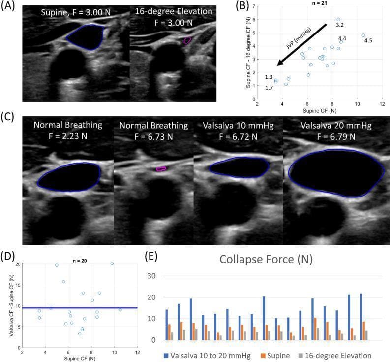 This composite educational graphic illustrates the biomechanical characteristics of the internal jugular vein (IJV) under varying physiological conditions. Panels A and C display B-mode ultrasound images in short-axis cross-sections. In Panel A, IJV compliance is demonstrated by comparing the supine position to 16-degree head elevation at a constant force of 3.00 N; blue outlines indicate a patent vessel, while a magenta dot signifies near-collapse due to decreased hydrostatic pressure. Panel C shows the effect of the Valsalva maneuver; as airway pressure increases from normal breathing to 20 mmHg, the IJV cross-sectional area expands significantly despite high probe forces (~6.7 N), highlighting increased venous pressure. Panels B and D provide scatter plots correlating 'Supine Collapse Force' (CF) with the change in force required for collapse during elevation and Valsalva, respectively. Panel E is a multi-subject bar graph summarizing individual variations in collapse force across three states: Valsalva (highest force required), supine (intermediate), and 16-degree elevation (lowest), serving as a diagnostic tool for evaluating central venous pressure non-invasively.