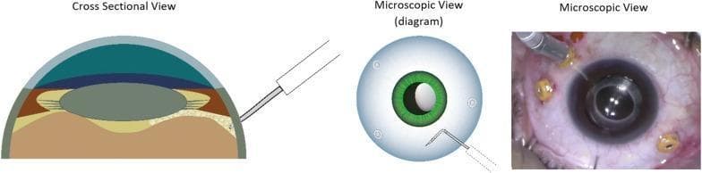 This composite educational graphic illustrates the surgical technique of pneumatic dissection of the anterior hyaloid membrane (AHM) during ophthalmic surgery. It consists of three panels: a cross-sectional diagram, a top-down microscopic diagram, and a real-time intraoperative surgical photograph. The cross-sectional view details the ocular anatomy, including the cornea, anterior chamber, iris, crystalline lens, and the posterior segment layers (sclera and choroid/retina). A 30-gauge needle is shown entering through the pars plana, with the tip positioned posterior to the lens. The top-down diagram illustrates the needle orientation relative to the iris and limbus. The clinical photograph demonstrates the actual surgical field, showing an eye with multiple sclerotomy cannulas (trocars) in place and a needle-mounted syringe performing the air injection near the pupillary margin. The primary educational focus is on the safe entry and positioning of the needle tip behind the lens within the vitreous cavity to facilitate AHM dissection while avoiding iatrogenic damage to the lens or retina.