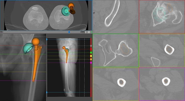 This composite diagnostic image illustrates an orthopedic preoperative planning simulation for a total hip arthroplasty (THA) in a 46-year-old female with Crowe III developmental dysplasia of the hip. The visualization combines multiple modalities: a full-length coronal X-ray of the femur showing the anatomical stem placement (orange), and several axial CT scan slices providing cross-sectional views of the femoral canal and pelvis. A 3D anatomical model of the prosthesis, including a turquoise acetabular cup and an orange femoral stem with a spherical head, is superimposed on the radiographic data. Key features shown include the native femoral anteversion (60°) and the simulated cup anteversion (16°). The layout demonstrates the spatial relationship and fit of the implant at various anatomical levels. The simulation evaluates parameters such as combined anteversion, offset restoration, and canal filling. In this specific case, the reconstruction is categorized as unacceptable because the combined anteversion exceeds the clinical limits established by Dorr and Widmer, highlighting the challenges of anatomical stem designs in patients with severe femoral dysplasia.