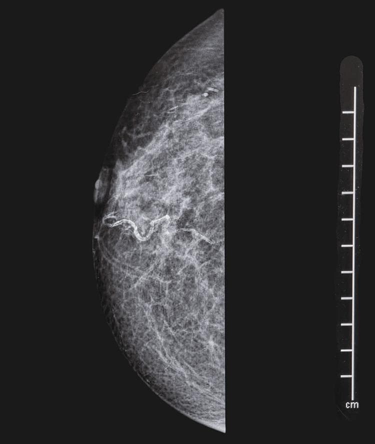 This diagnostic image is a craniocaudal (CC) view mammogram of the right breast. The breast tissue exhibits a scattered fibroglandular density pattern, where approximately 25% of the parenchyma consists of glandular tissue interspersed with fatty areas. Centrally, there is evidence of slight nipple inversion. A notable feature is the presence of increased radiodensity/echogenic material within the retroareolar lactiferous ducts, which appear prominent and tubular as they extend from the nipple into the deeper breast parenchyma. No discrete, spiculated masses or suspicious clustered pleomorphic microcalcifications are identified in this view. This image serves as an educational example of evaluating ductal changes in patients presenting with clinical symptoms such as nipple discharge or inversion, often correlating with conditions like duct ectasia or underlying occult malignancy.