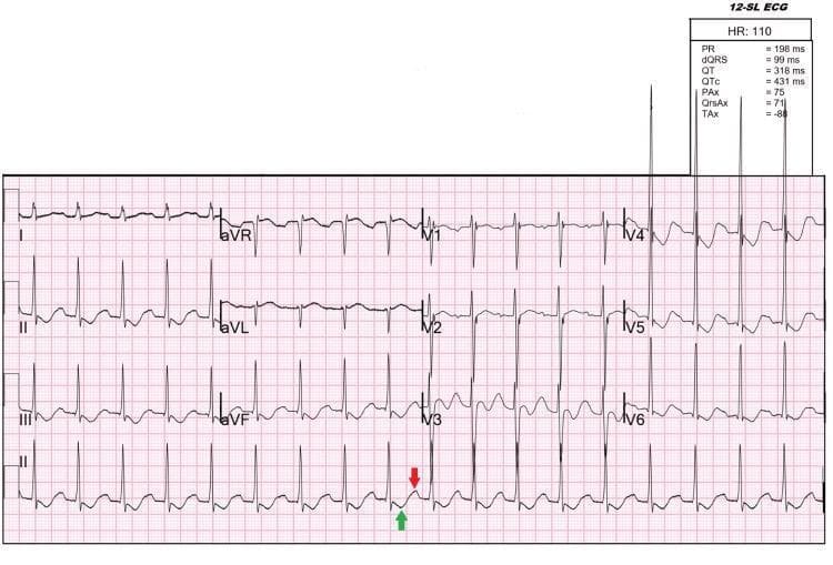This diagnostic image is a 12-lead electrocardiogram (ECG) demonstrating classic features of severe hypokalemia in a patient with thyrotoxic periodic paralysis. The tracing shows sinus tachycardia with a heart rate of approximately 110 beats per minute. Key visible abnormalities include prominent U waves, most notably in leads V2 through V6 (indicated by a red arrow in lead V3), and T-wave inversion (marked with a green arrow in lead V3). The U waves are positive deflections that appear after the T waves, separated by a brief isoelectric period. Additionally, there are inverted T waves in the inferior leads (III and aVF) and mid-precordial leads. Automated measurements indicate a PR interval of 198 ms, QRS duration of 99 ms, and a QTc of 431 ms. The combination of tachycardia, T-wave inversion, and prominent U waves is clinically significant for identifying severe electrolyte disturbances like hypokalemia (1.7 mEq/L in this case) which can occur during thyrotoxic crisis or periodic paralysis.